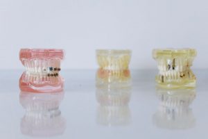 Dentures or Dental Implants